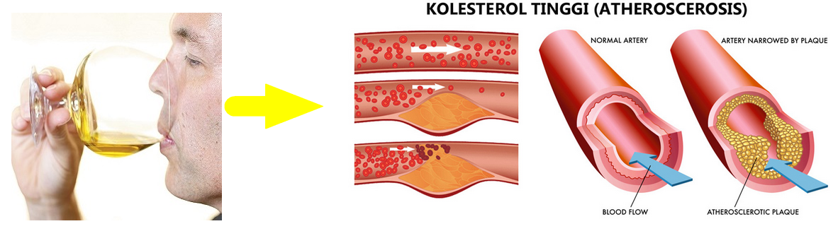 Cara Minum Minyak Zaitun Untuk Menurunkan Kolesterol Cara_Minum_Minyak_Zaitun_Untuk_Menurunkan_Kolesterol